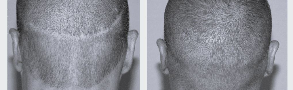 SMP for Hair Transplant Clients